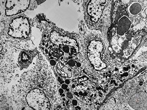 M,61y. | spleen - hemangioma v.s. … erythrophagocytosis M,61y. | spleen - hemangioma v.s. … erythrophagocytosis